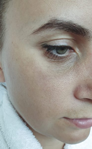 Augenfalten Behandlung