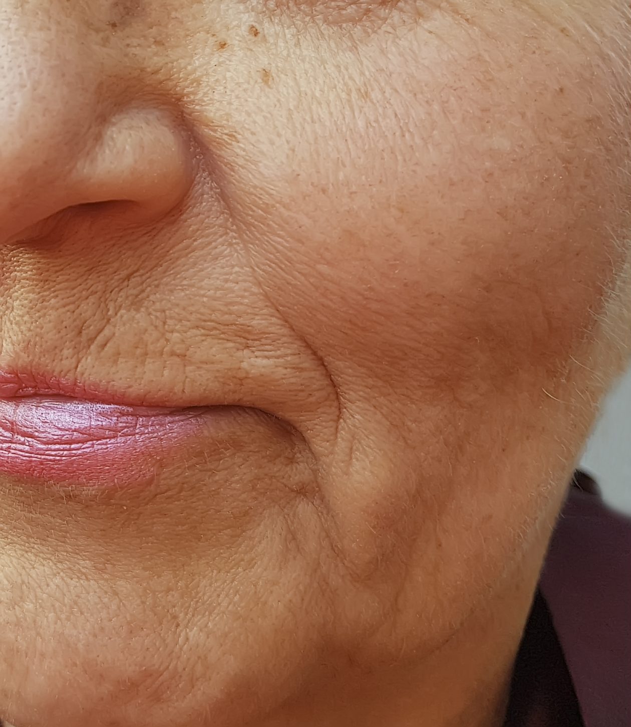 Marionettenfalte Behandlung